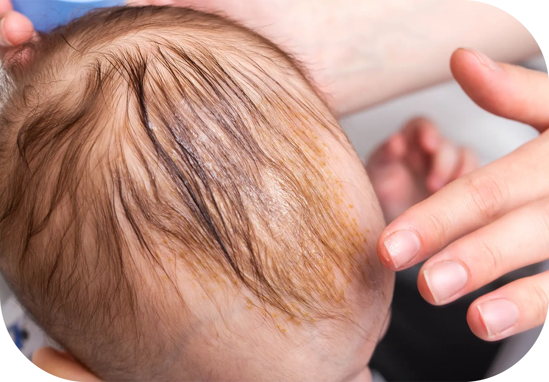 prevenir y tratar la costra láctea en bebés